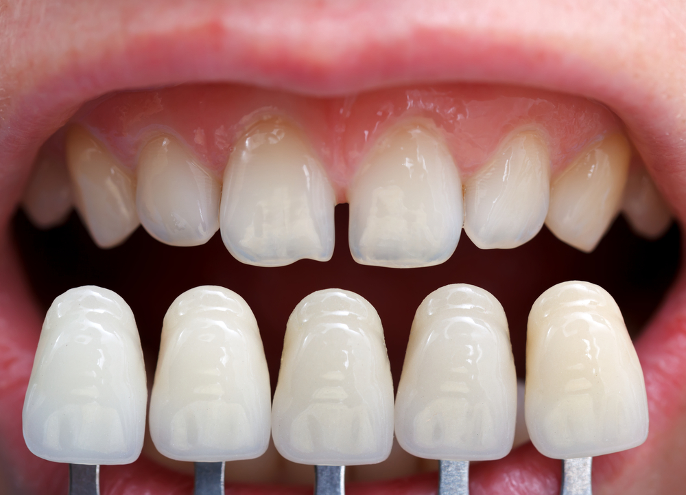 How to Decide if Dental Veneers are the Right Choice for You